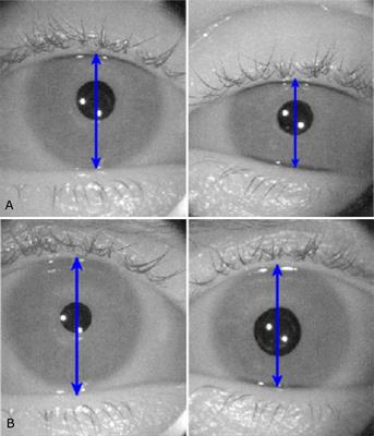 Apraclonidine—An eye opener